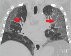 A CT scan of lungs