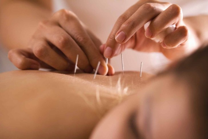 The doctor sticks needles into the girl's body on the acupuncture